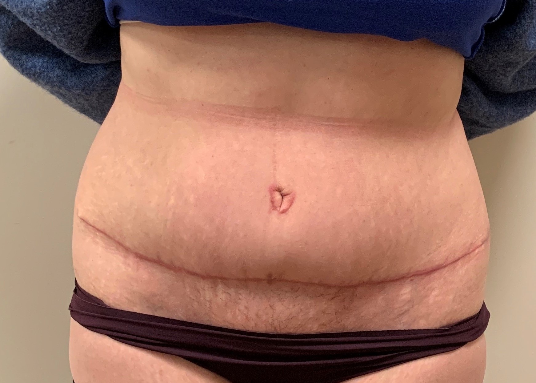 tummy tuck recovery time